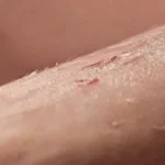 Close-up of healing