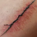 Close-up of inflamed