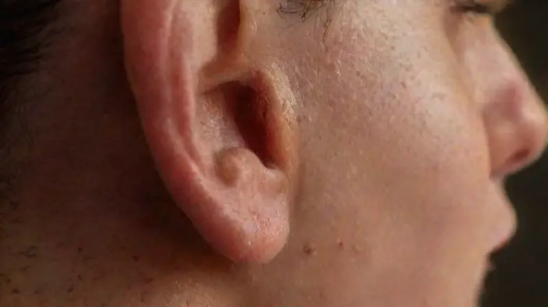 Healed ear with scar and realistic details