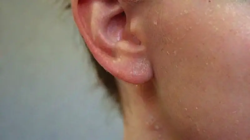 Close-up of girl’s freshly pierced earlobe
